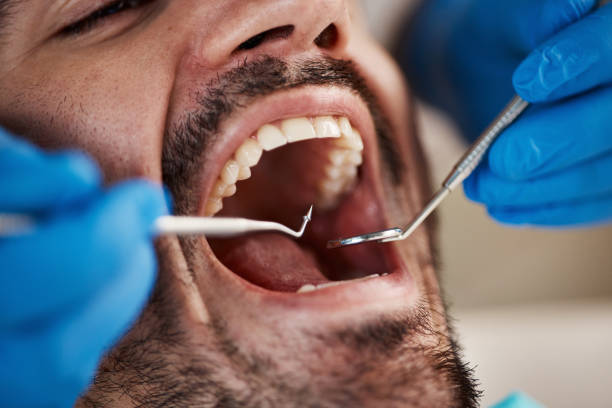 Best Root Canal Emergency Dentist  in Alvord, TX